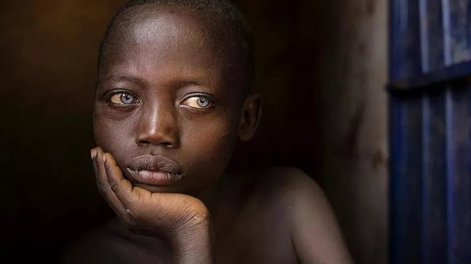 Σουδάν: Η UNICEF προειδοποιεί ότι 700.000 παιδιά κινδυνεύουν από τη χειρότερη μορφή υποσιτισμού