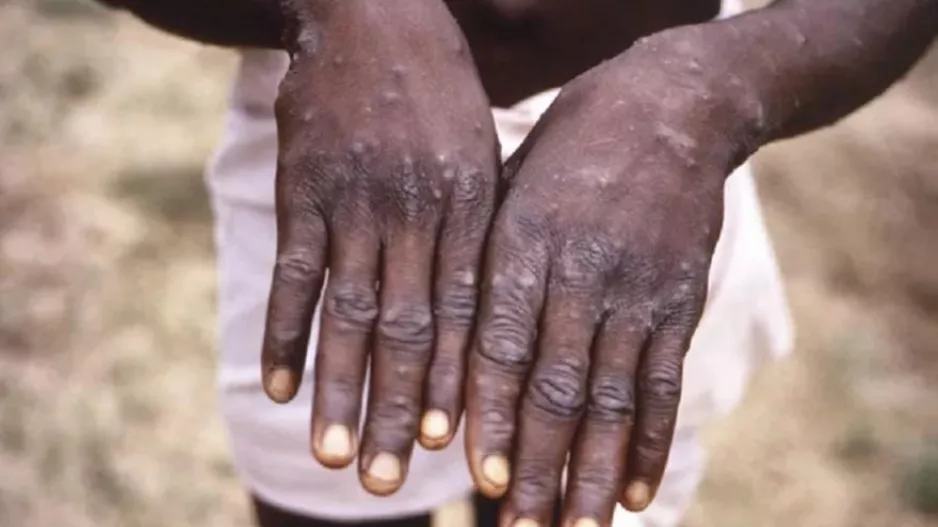 Σχεδόν 30.000 ύποπτα κρούσματα mpox καταγράφηκαν φέτος στην Αφρική, σύμφωνα με τον ΠΟΥ
