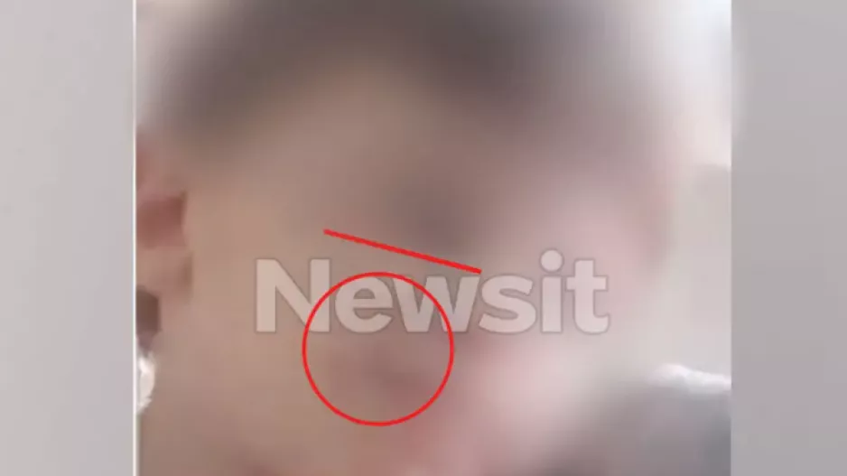 Ανέβαζε βίντεο στο Tiktok με τα σημάδια της κακοποίησης στο προσωπάκι του τρίχρονου Άγγελου