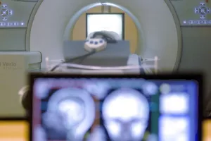 Σπάνιο ιατρικό περιστατικό: Αφαίρεσαν έμβρυο από το κεφάλι παιδιού!