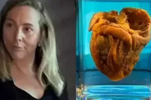 Γυναίκα είδε την καρδιά της σε μουσείο μετά από 16 χρόνια αφότου την αφαίρεσε