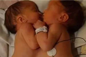 Πώς είναι οι σιαμαίες δίδυμες που οι γιατροί χώρισαν πριν από 20 χρόνια