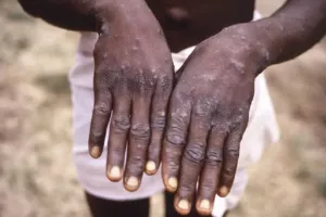 Σχεδόν 30.000 ύποπτα κρούσματα mpox καταγράφηκαν φέτος στην Αφρική, σύμφωνα με τον ΠΟΥ