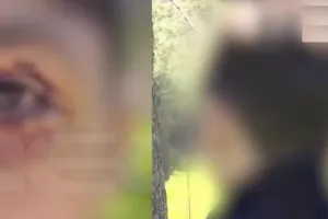 Άγρια επίθεση από ανήλικους σε 16χρονο – Παραλίγο να χάσει το μάτι του
